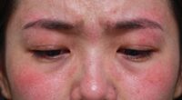 skin reacting to stress